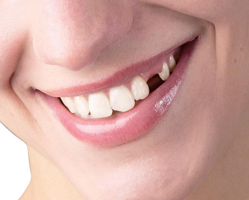 Cum pot fi inlocuiti dintii lipsa?